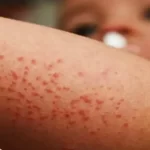 Brote de sarampión en EE.UU. casos no vacunados